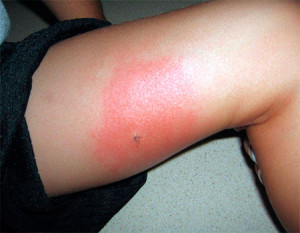 Аллергическая реакция на укус таракана
