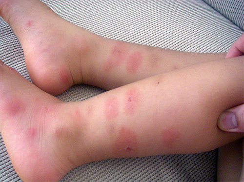 allergiya-na-ukusy-klopov-4